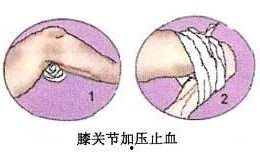 加压包扎止血法视频,关键时刻的急救技能解析