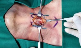 环甲膜切开术视频,环甲膜切开术操作步骤及要点解析